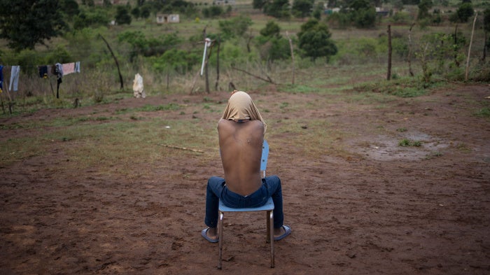 A boy shows a scar on his back allegedly from a rubber bullet 