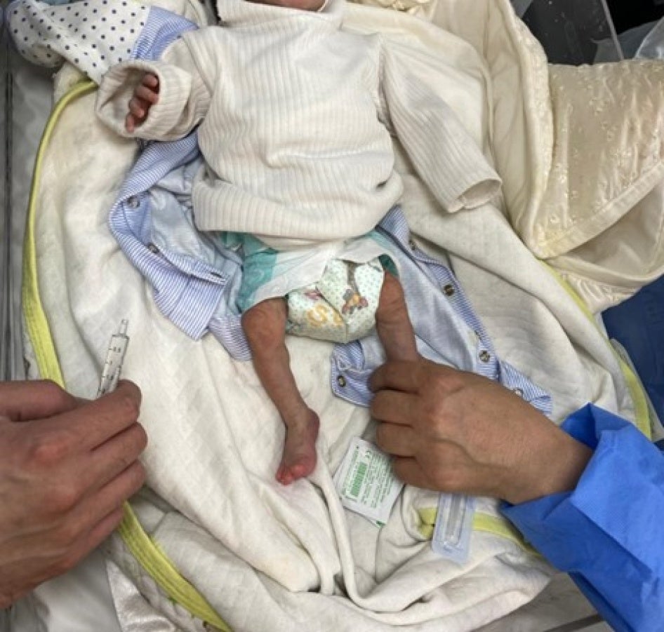 A photograph of a severely malnourished and dehydrated infant at al-Hilal Emirates hospital