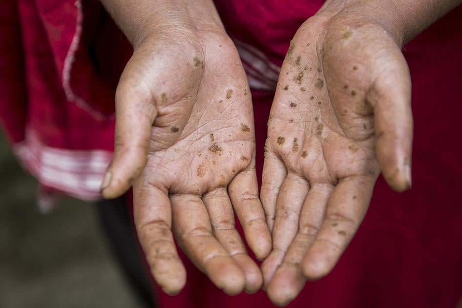 Hands of Selina Aktar, a woman in her late 30s with arsenic-related health conditions that first began appearing 20 years ago. 